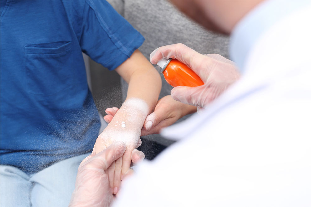 Second-degree burns – Symptoms, management, and stages of healing